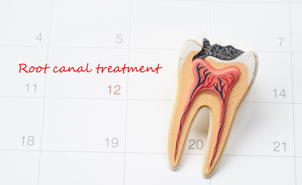 What to Know Before Having a Root Canal With Braces