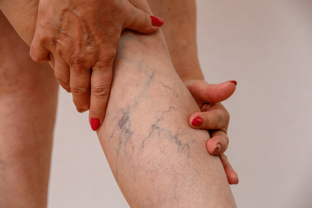 Radiofrequency Ablation for Vein Health